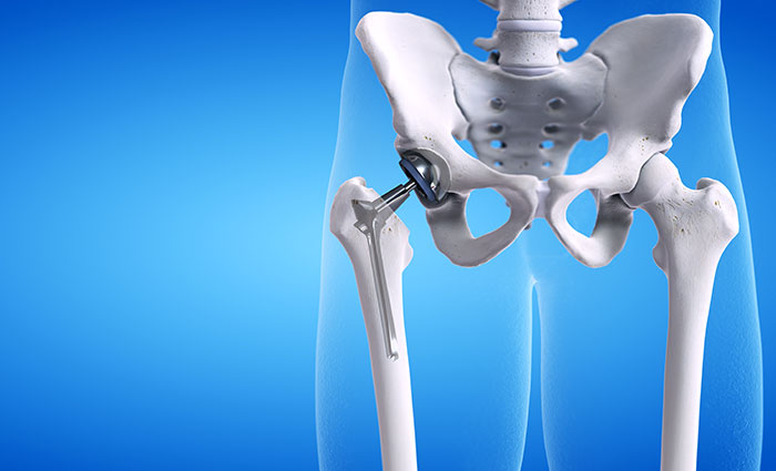 what is a total hip replacement